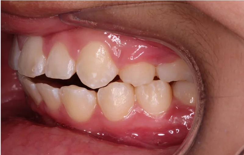 Left Buccal - Before Treatment