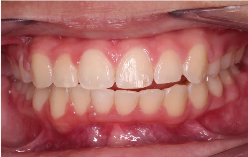 Center Bite - Before Treatment