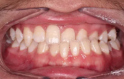 Before Metal Braces treatment - Case 86890