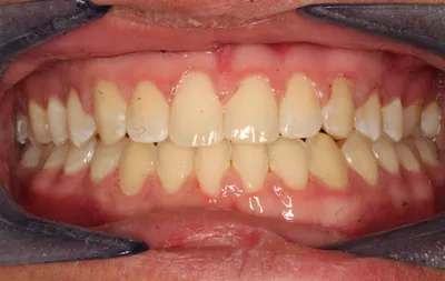 After Metal Braces treatment - Case 86890