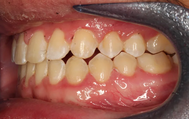 Left Buccal - After Treatment