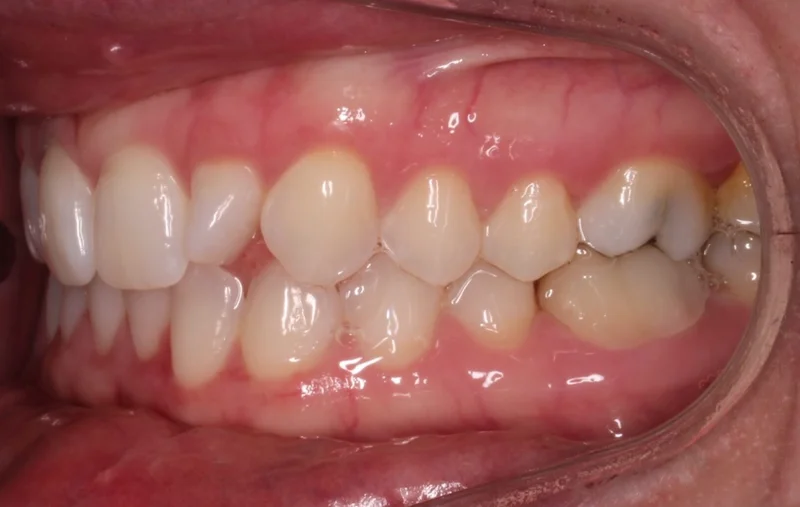Left Buccal - Before Treatment