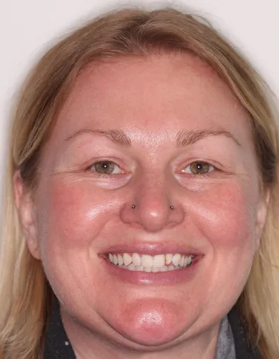 Before Clear Braces treatment - Case 86915