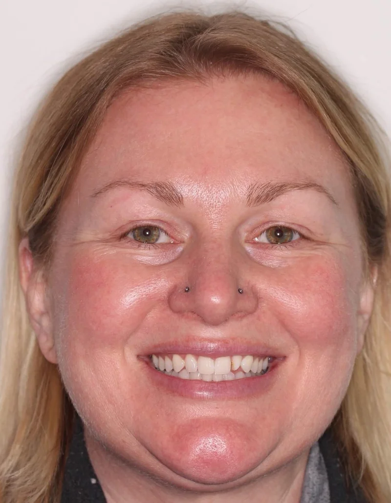 Facial Frontal Smiling - Before Treatment