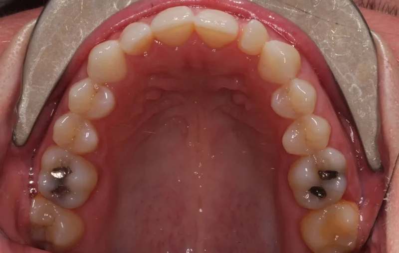 Upper Occlusal - Before Treatment