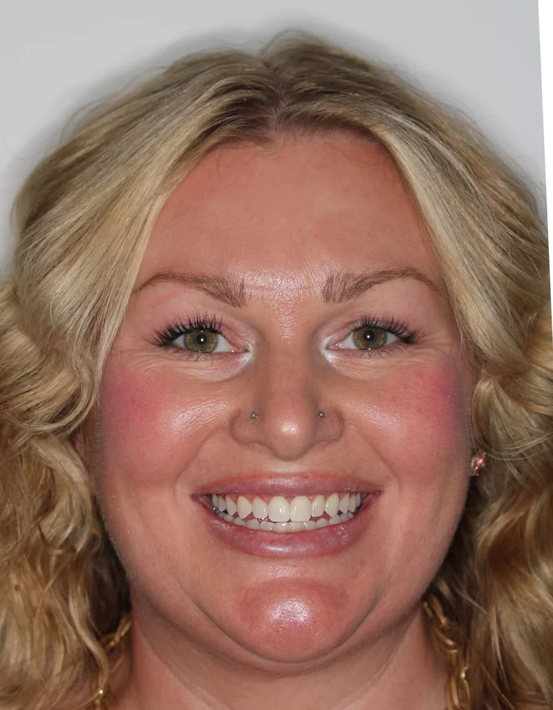 Facial Frontal Smiling - After Treatment