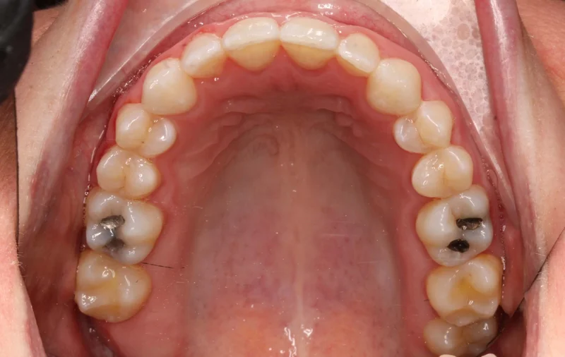 Upper Occlusal - After Treatment