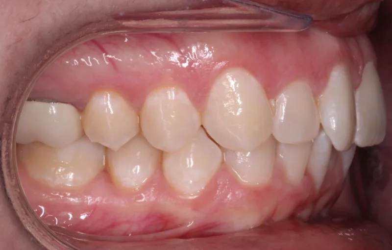 Right Buccal - Before Treatment