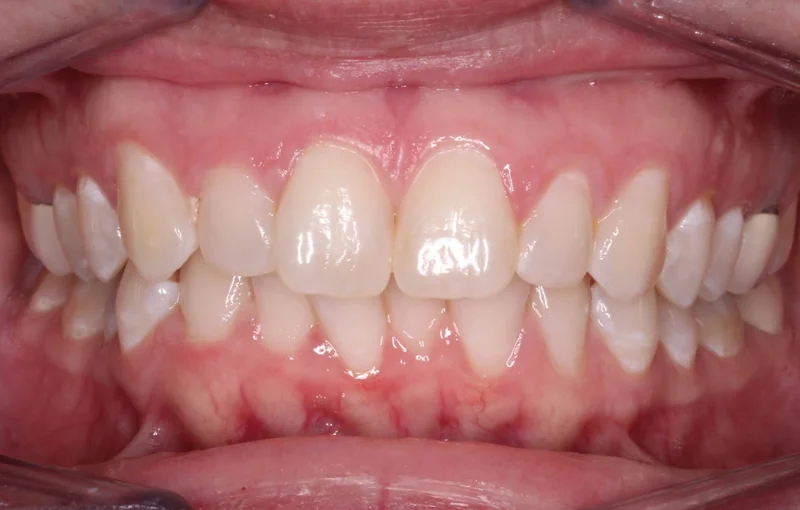 Center - Before Treatment