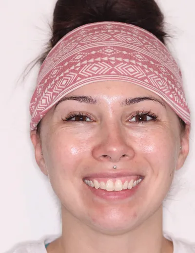 Before Metal Braces treatment - Case 86921