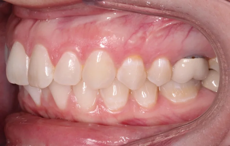 Left Buccal - Before Treatment