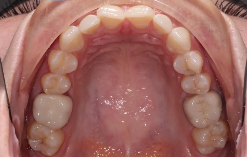 Upper Occlusal - Before Treatment