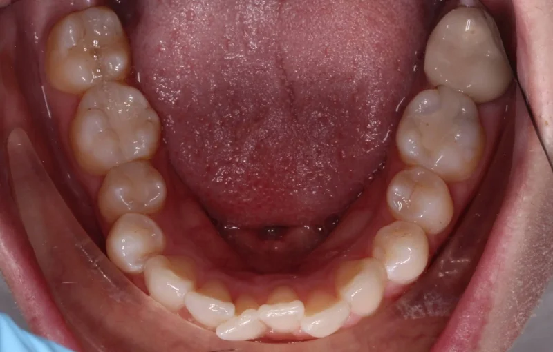 Lower Occlusal - Before Treatment