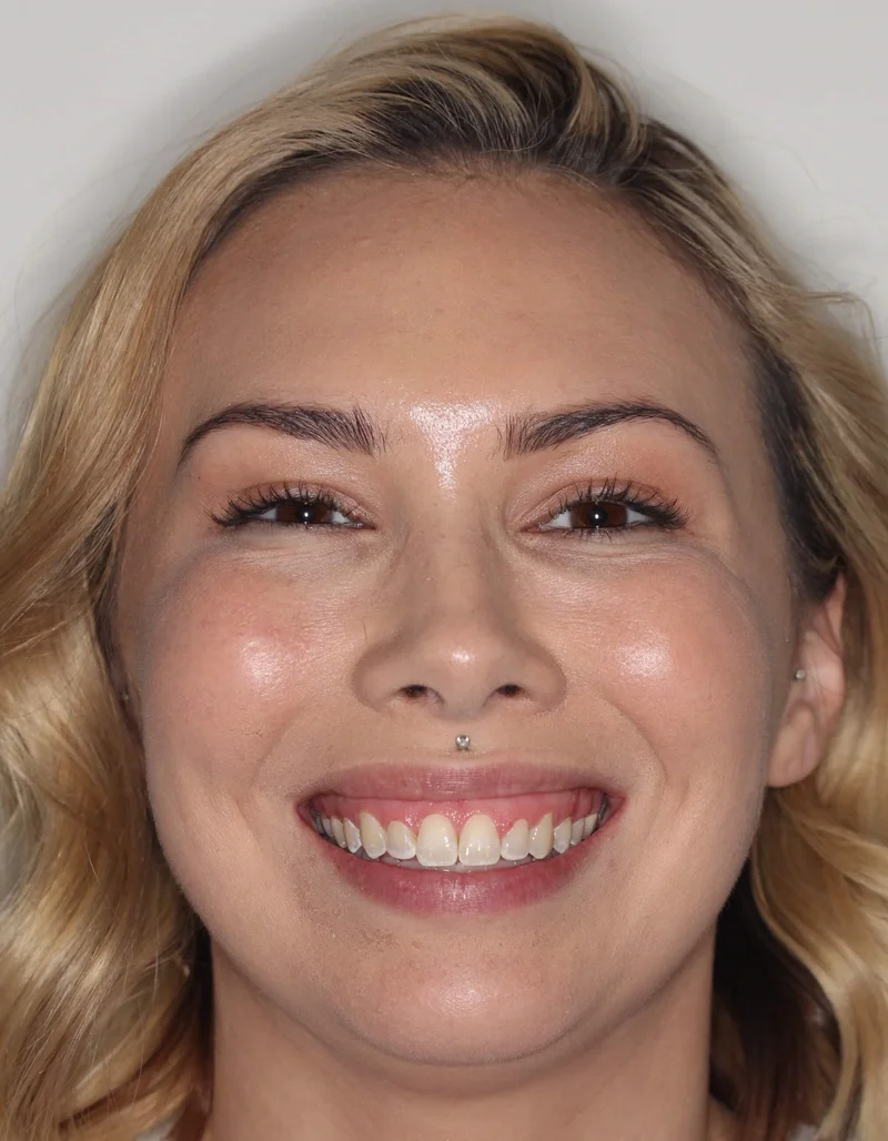 Facial Frontal Smiling - After Treatment