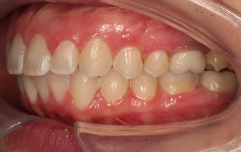 Left Buccal - After Treatment
