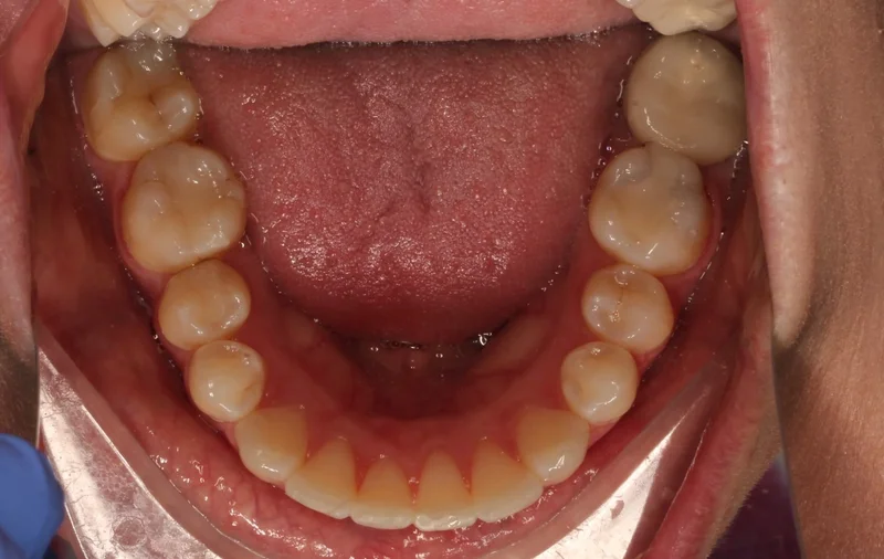 Lower Occlusal - After Treatment