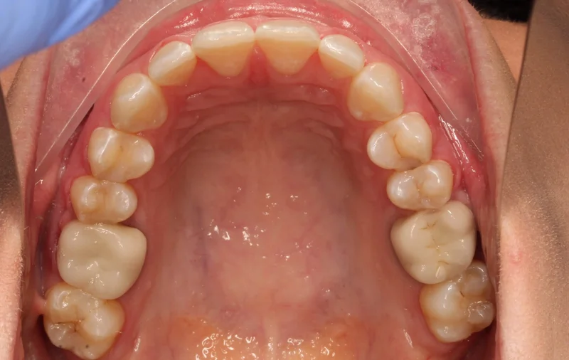Upper Occlusal - After Treatment