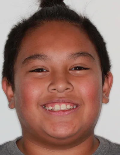 Before Metal Braces treatment - Case 87298