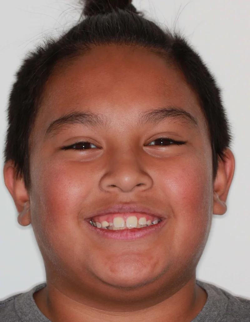 Facial Smiling - Before Treatment