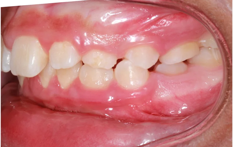 Left Buccal - Before Treatment