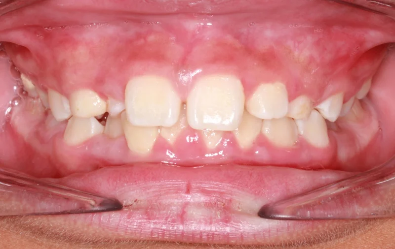 Center Bite - Before Treatment