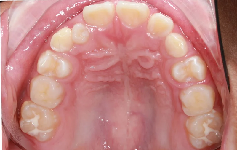 Upper Occlusal - Before Treatment