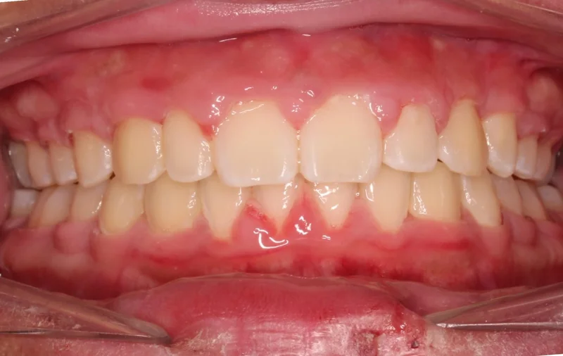 Center Bite - After Treatment