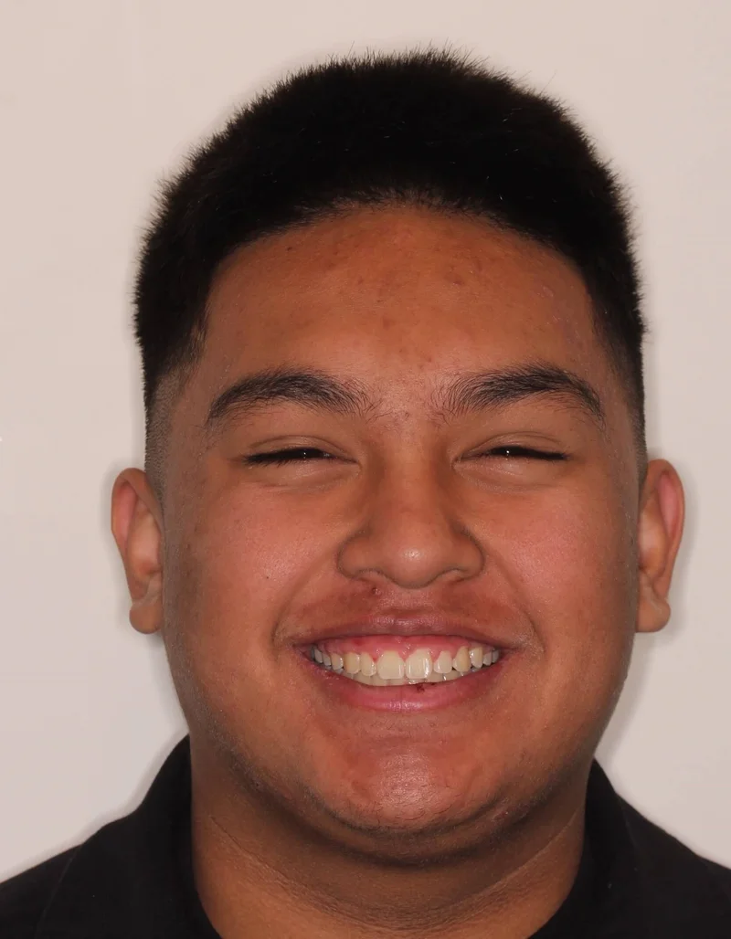 Facial Smiling - After Treatment