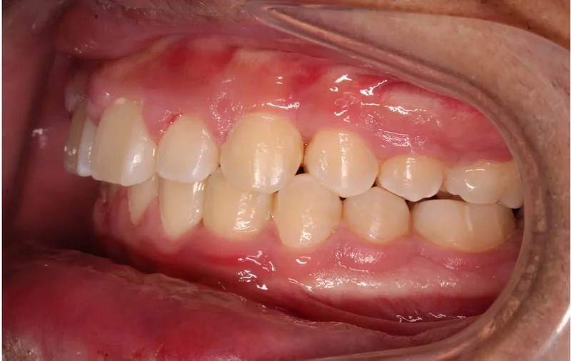 Left Buccal - After Treatment