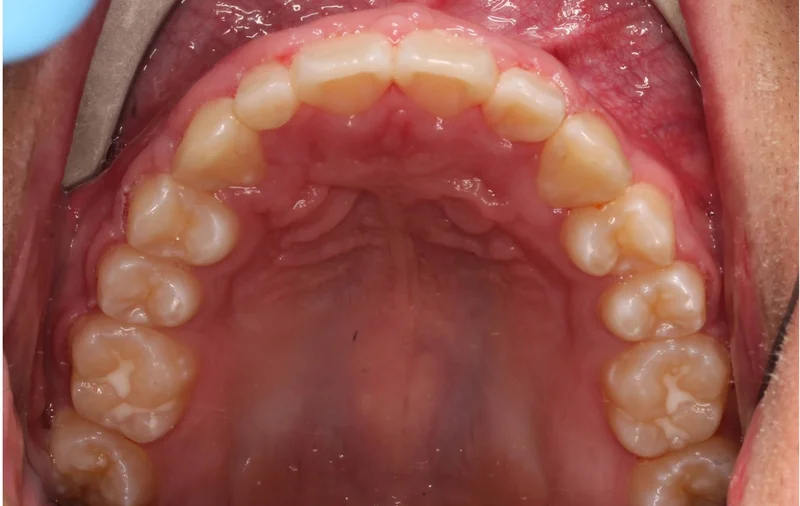 Upper Occlusal - After Treatment