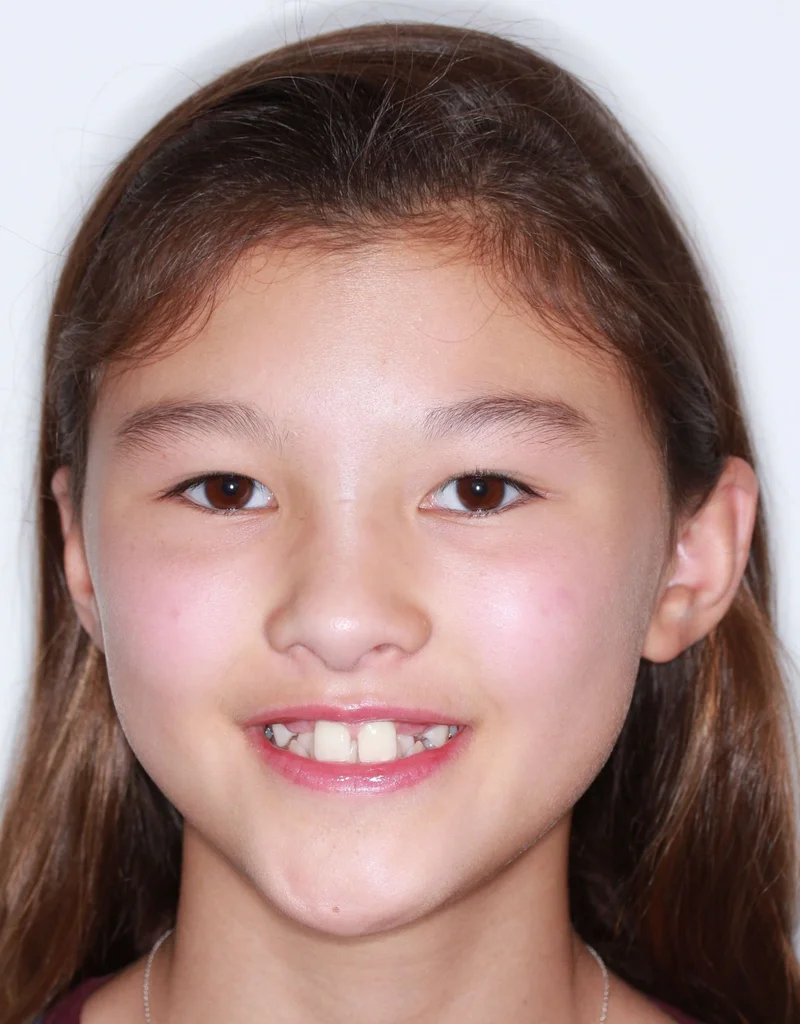 Facial Smiling - Before Treatment