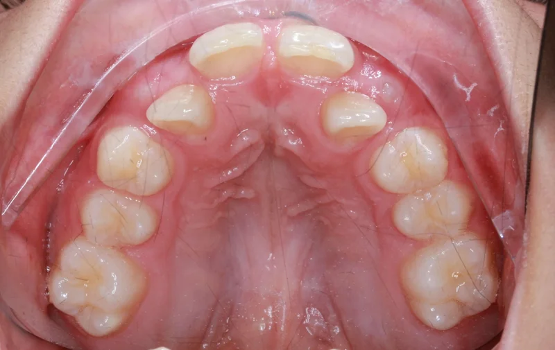 Upper Occlusal - Before Treatment