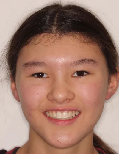 After Metal Braces treatment - Case 87299