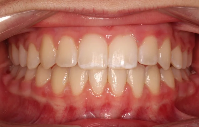 Center Bite - After Treatment
