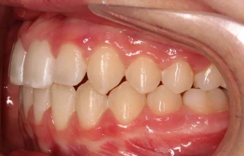Left Buccal - After Treatment