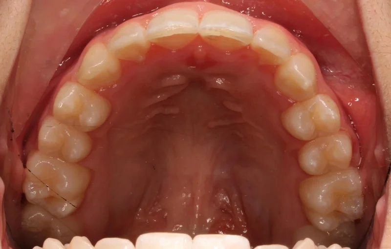 Upper Occlusal - After Treatment