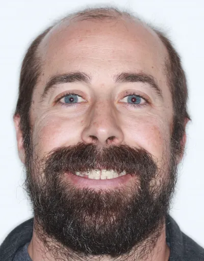 Before Metal Braces treatment - Case 87300