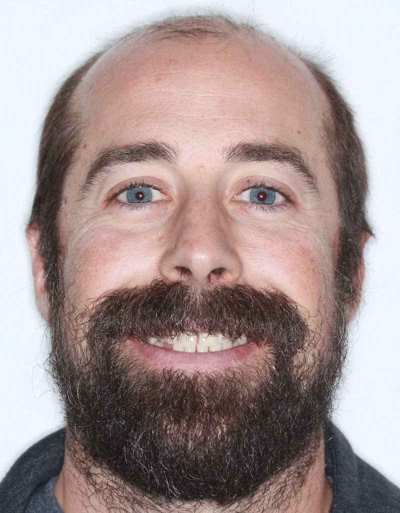 Facial Smiling - Before Treatment