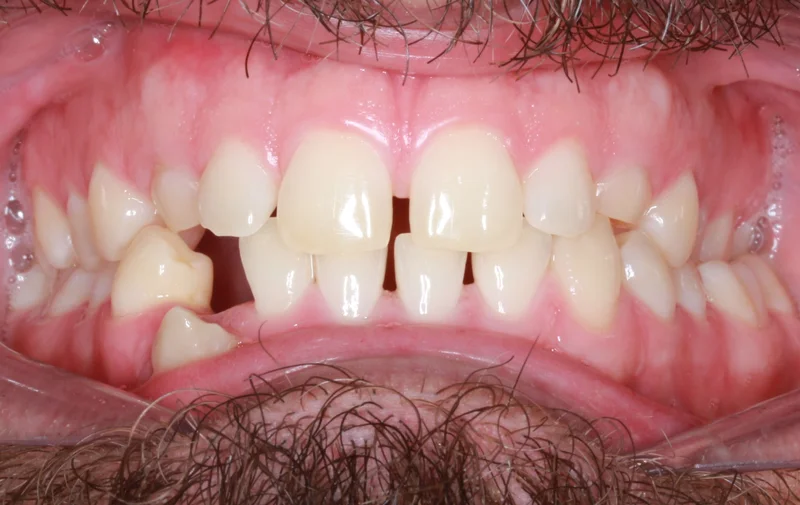 Center Bite - Before Treatment