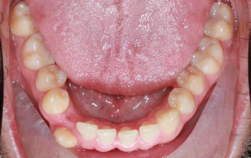 Lower Occlusal - Before Treatment