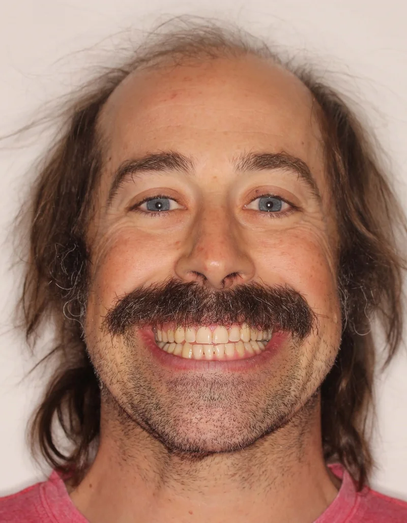 Facial Smiling - After Treatment