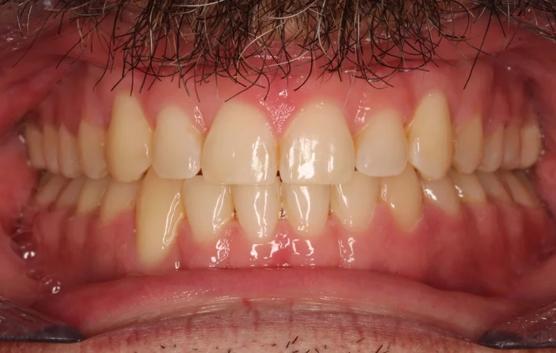 Center Bite - After Treatment