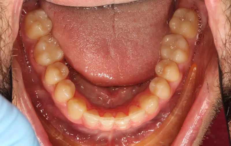 Lower Occlusal - After Treatment
