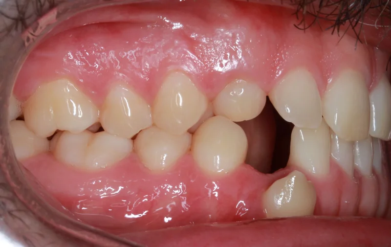 Right Buccal - Before Treatment