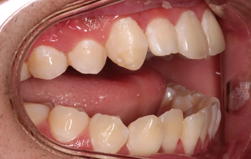 Right Buccal - Before Treatment