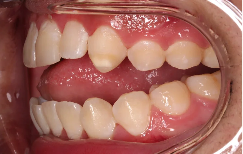 Left Buccal - Before Treatment