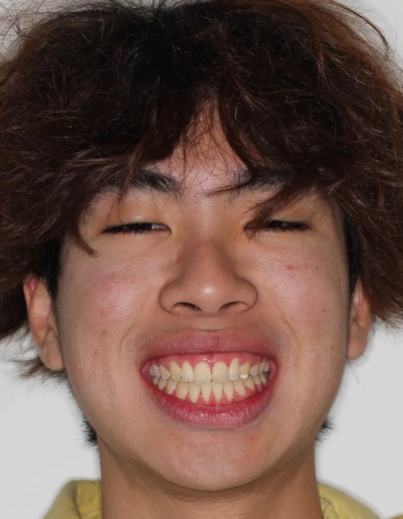 Facial Frontal Smiling - After Treatment