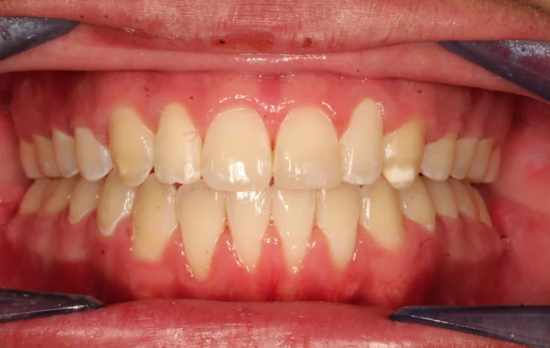 Center - After Treatment