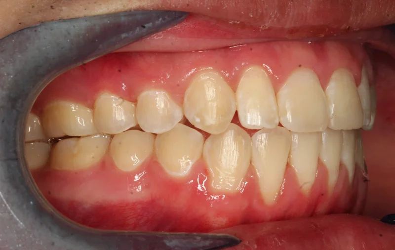 Right Buccal - After Treatment