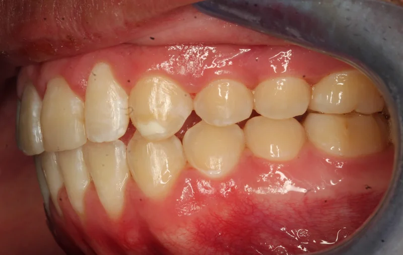 Left Buccal - After Treatment